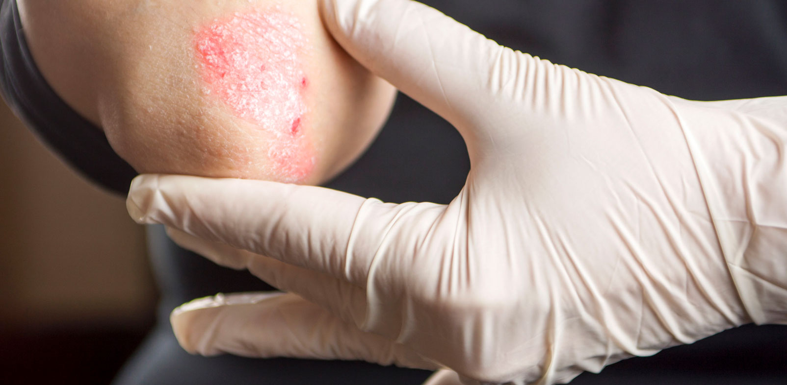 Psoriasis Identification & Reasons of Worst Condition