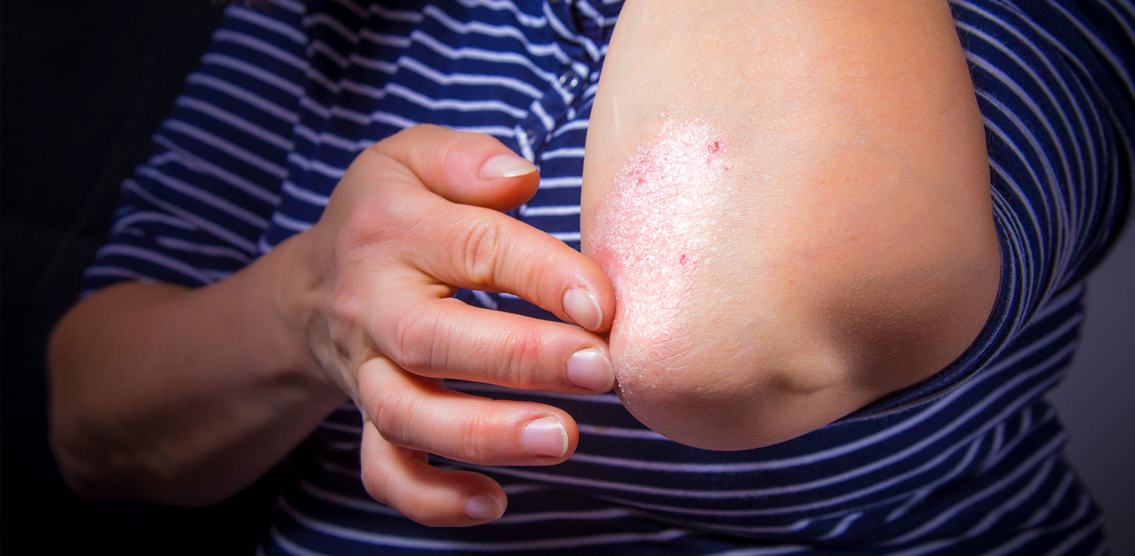 How Psoriasis Cream Give Relief to Infected Skin?